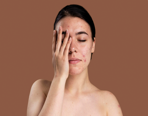 Acne treatment